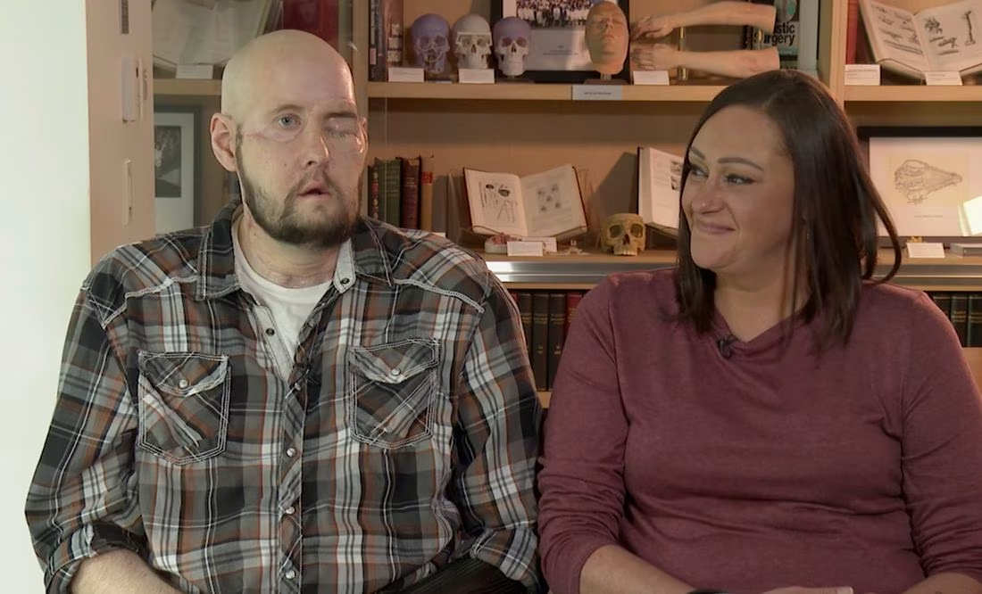 Histórico trasplante de ojo y media cara en Nueva York